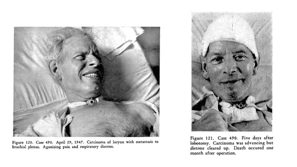 Lobotomy example